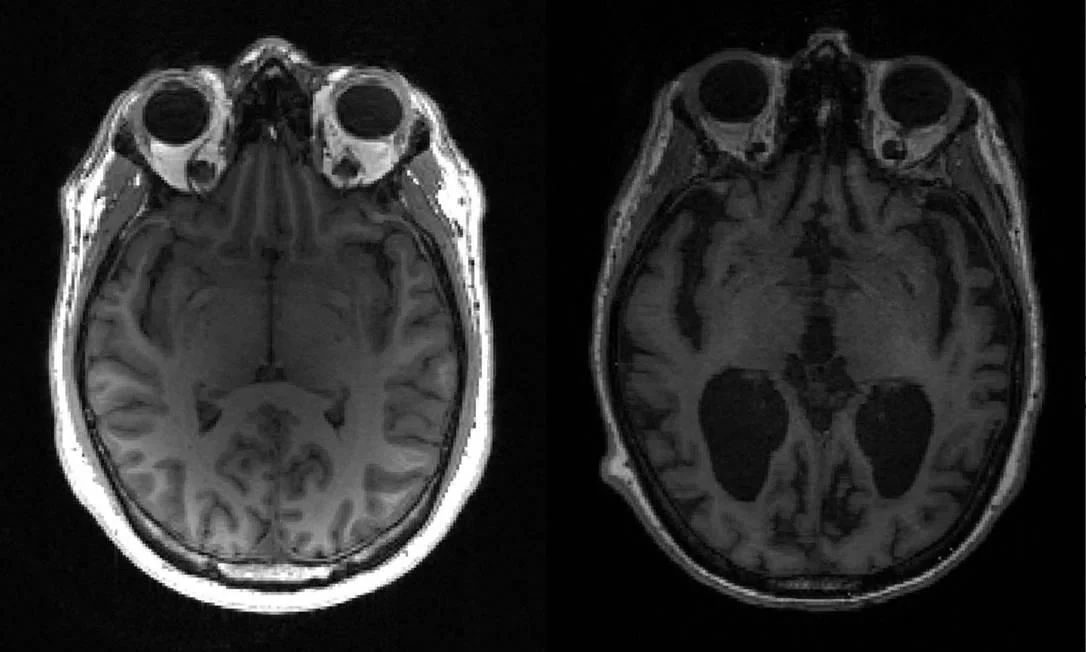 Vacina contra Alzheimer será testada em humanos na Finlândia